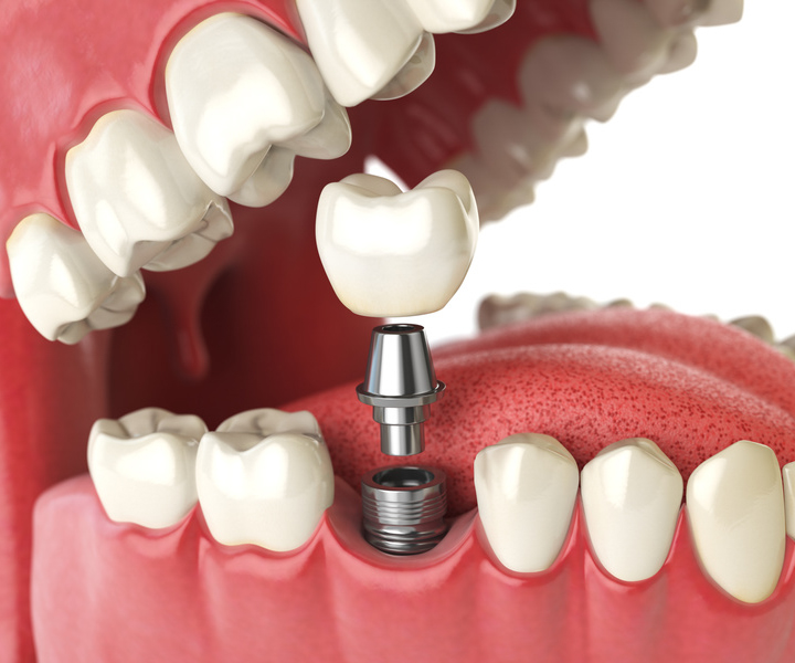 Tooth human implant. Dental concept. Human teeth or dentures. 3d illustration